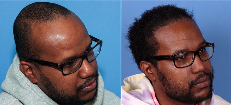 NeoGraft Hair Restoration Before & After Gallery - Patient 121124093 - Image 3