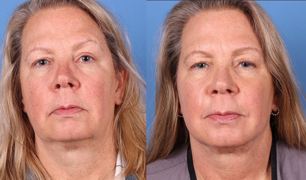 Face Lift Before & After Gallery - Patient 121124176 - Image 1