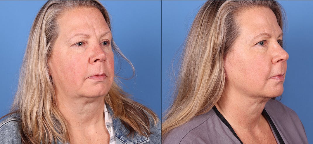 Face Lift Gallery - Patient 121124176 - Image 2
