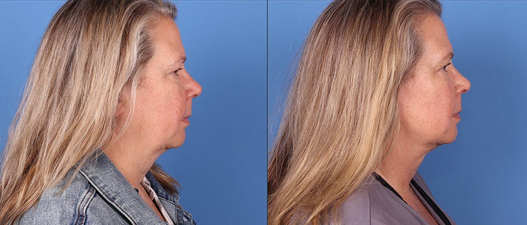 Face Before & After Gallery - Patient 149385113 - Image 3