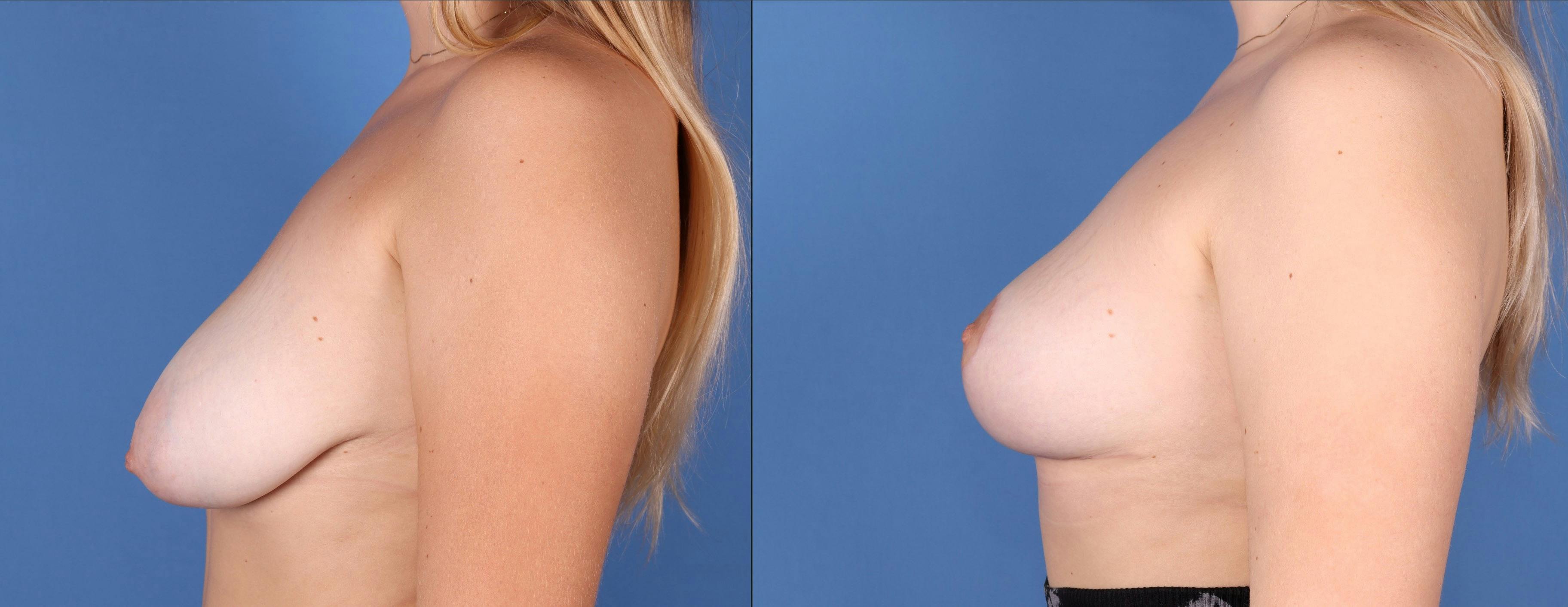 Breast Lift Before & After Gallery - Patient 121301014 - Image 3