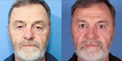Eyelid Surgery (Upper & Lower Blepharoplasty) Before & After Gallery - Patient 615611 - Image 1