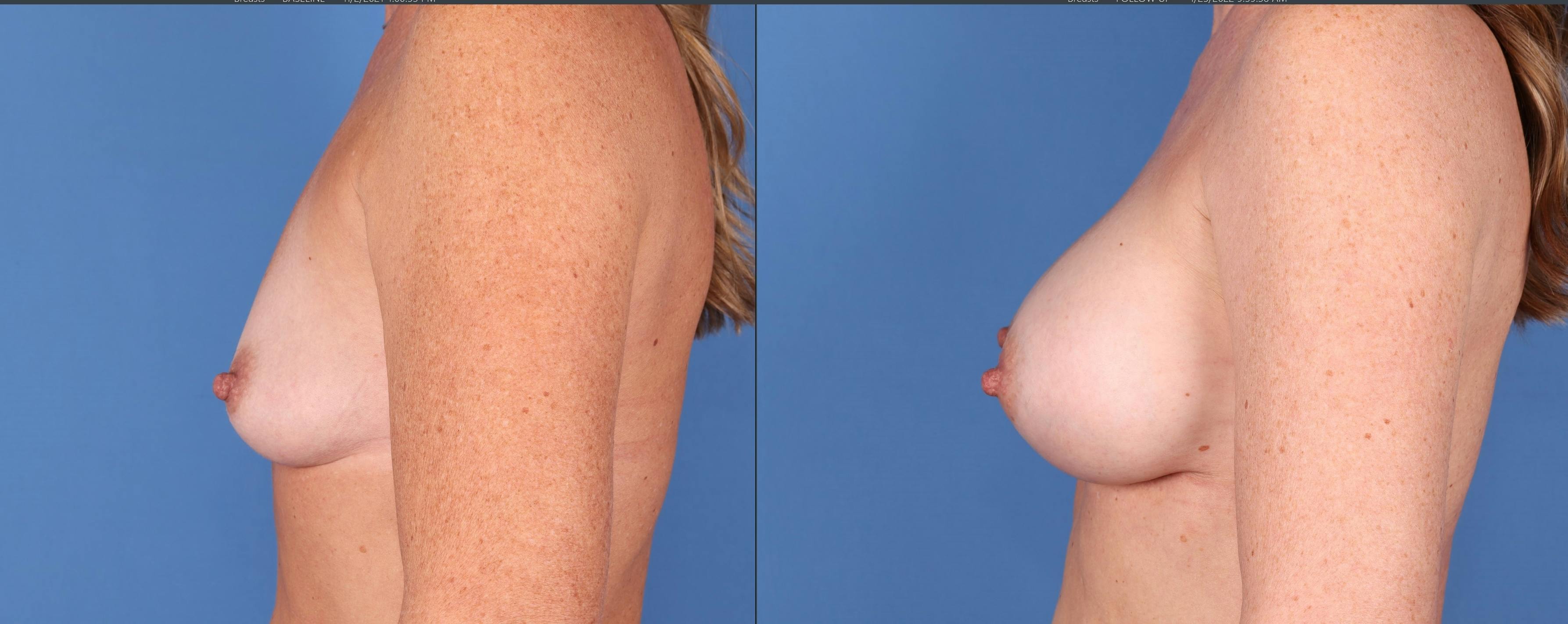 Breast Augmentation Before & After Gallery - Patient 121356464 - Image 2