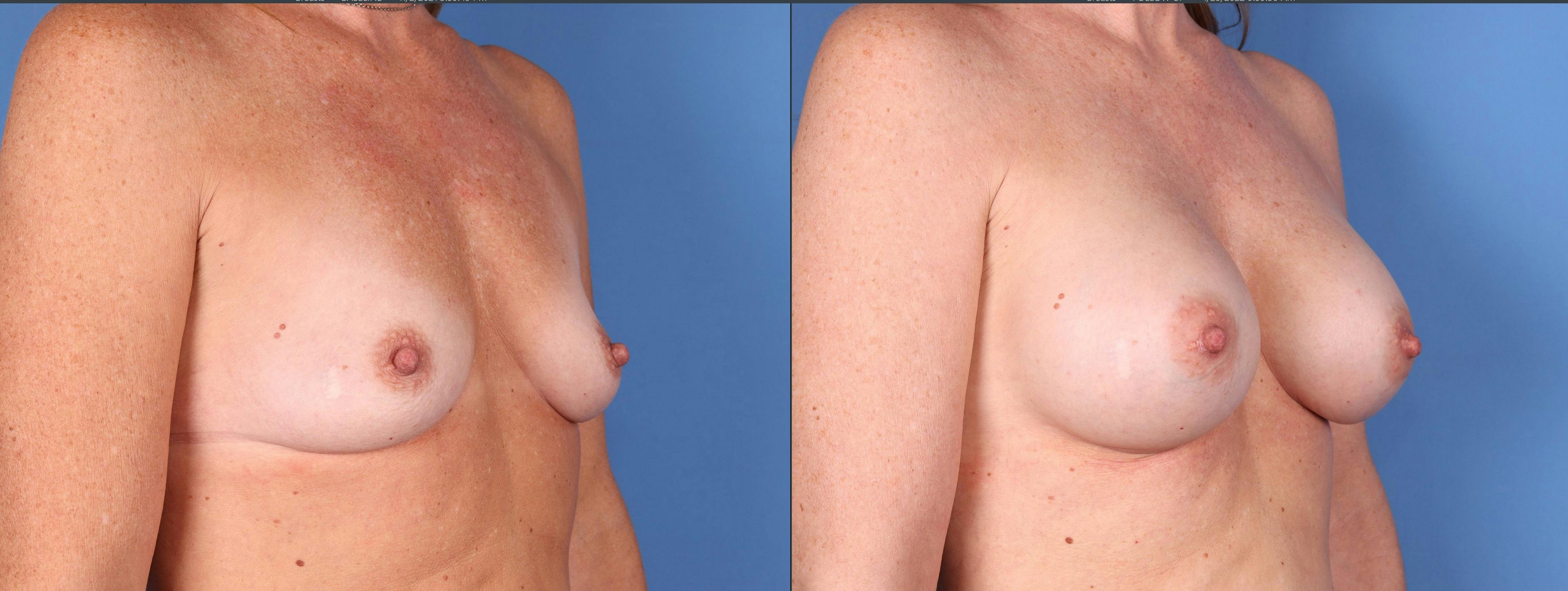 Breast Augmentation Before & After Gallery - Patient 121356464 - Image 3