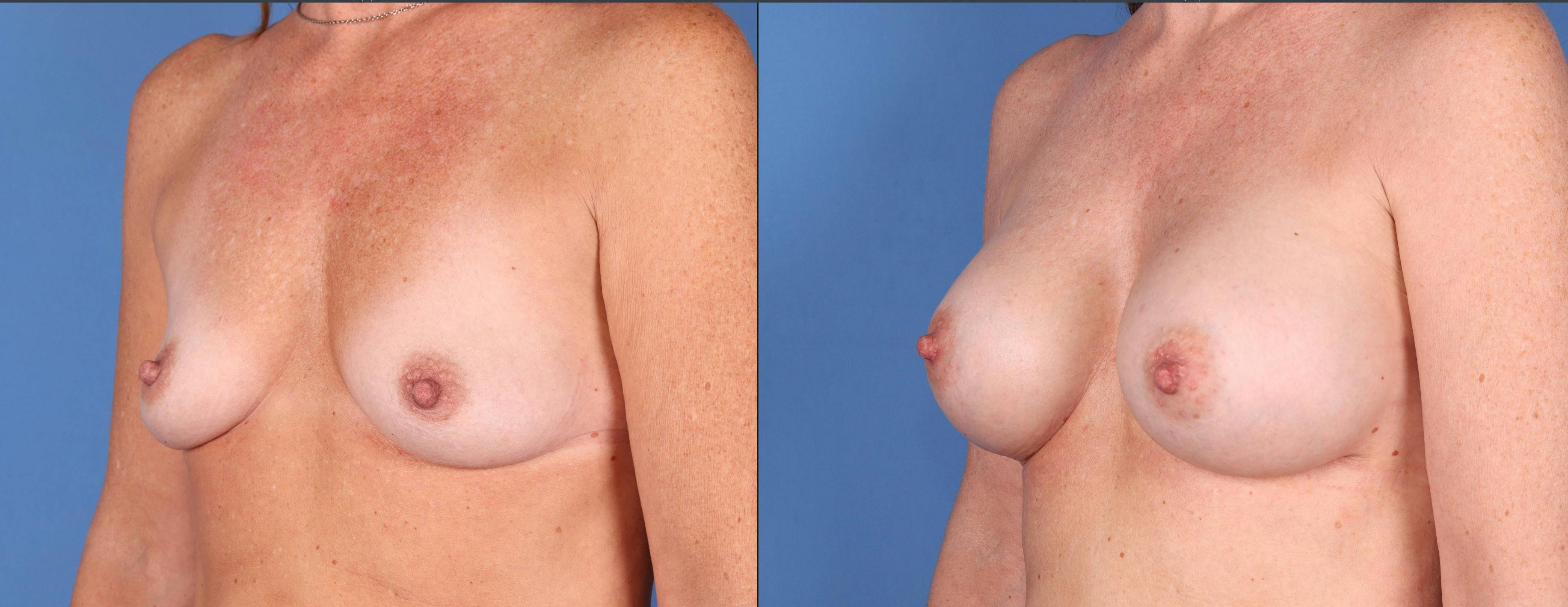 Breast Augmentation Before & After Gallery - Patient 121356464 - Image 4