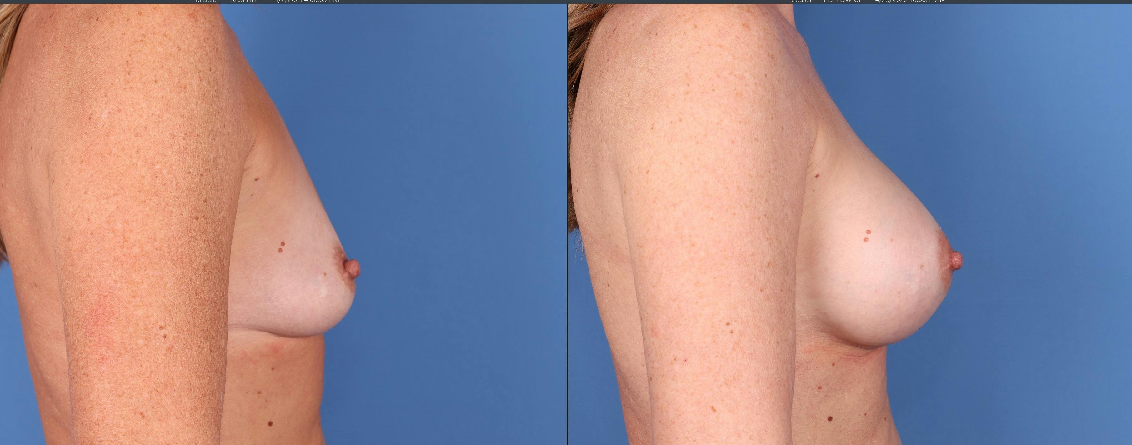 Breast Augmentation Before & After Gallery - Patient 121356464 - Image 5