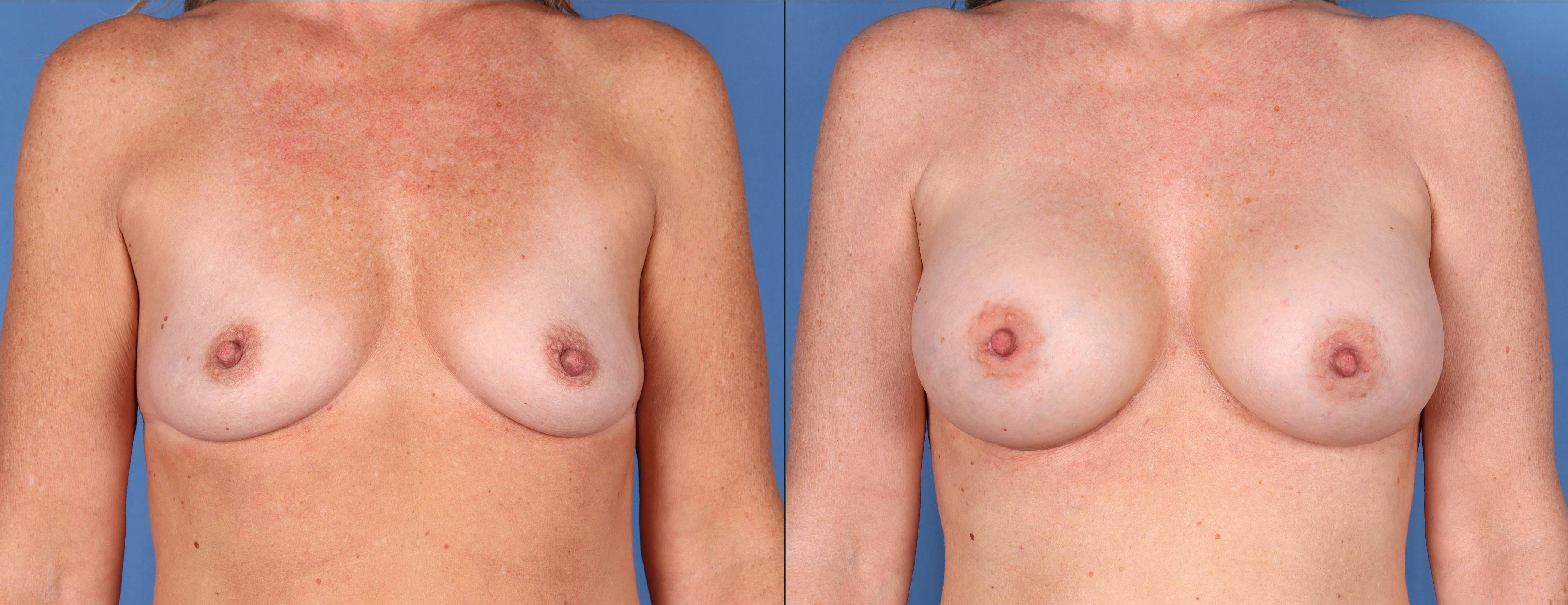 Breast Augmentation Before & After Gallery - Patient 121356464 - Image 1