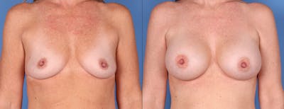 Breast Augmentation Before & After Gallery - Patient 121356464 - Image 1