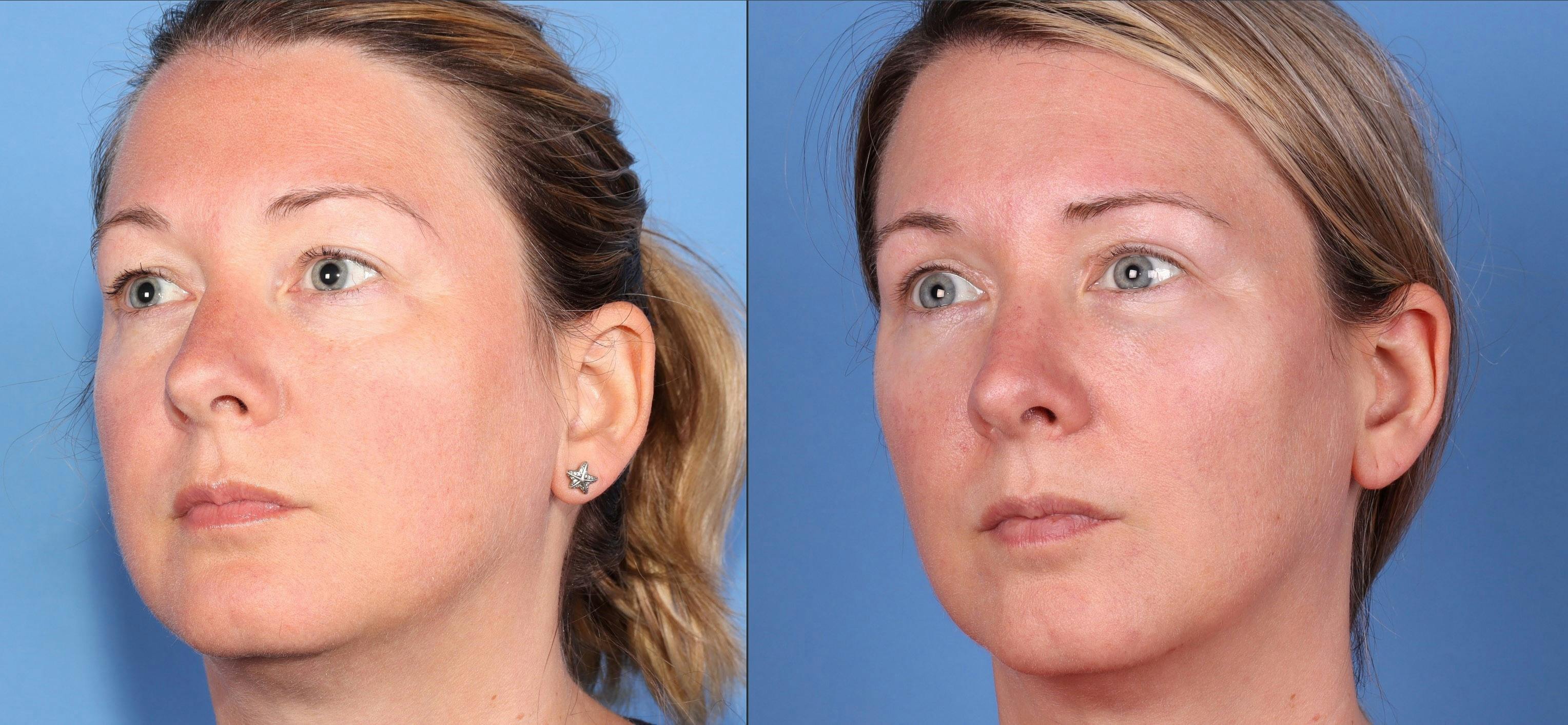 Eyelid Surgery (Blepharoplasty) Before & After Gallery - Patient 121356768 - Image 2