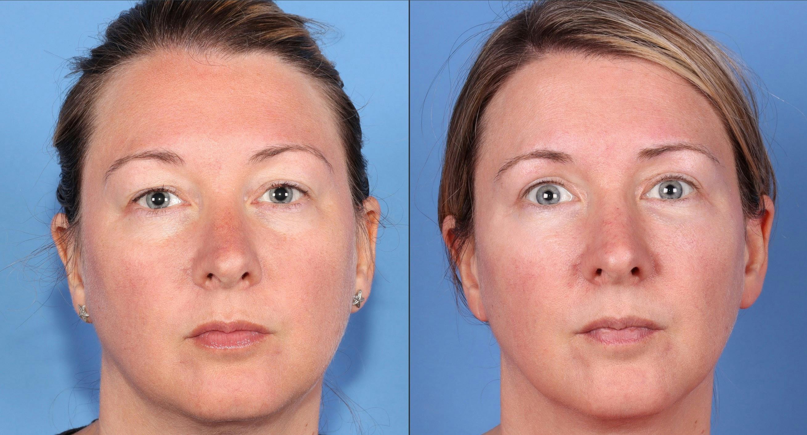 Eyelid Surgery (Blepharoplasty) Before & After Gallery - Patient 121356768 - Image 1