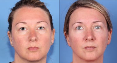 Eyelid Surgery (Upper Blepharoplasty) Before & After Gallery - Patient 121356768 - Image 1