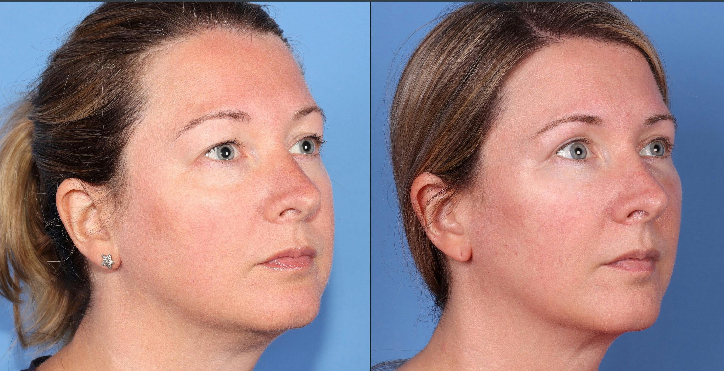 Eyelid Surgery (Blepharoplasty) Before & After Gallery - Patient 121356768 - Image 3