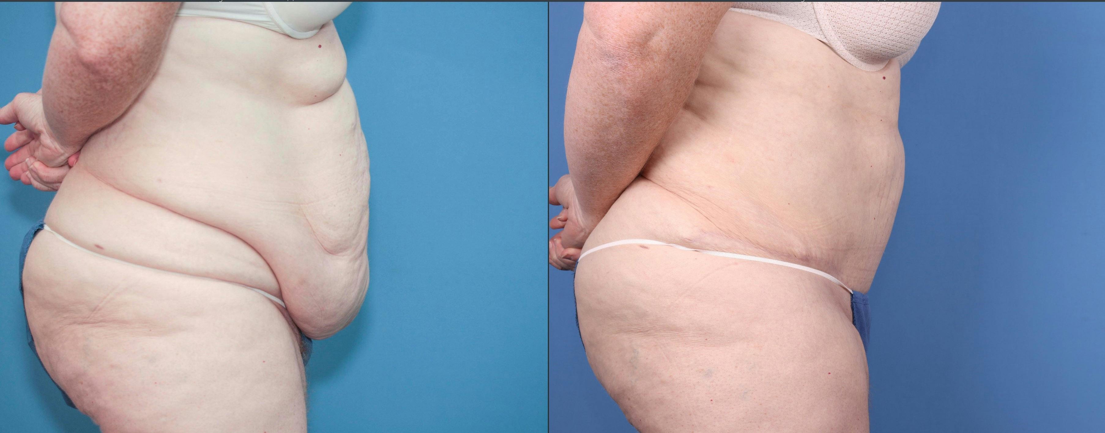 Thigh Lift Before & After Gallery - Patient 121459591 - Image 2