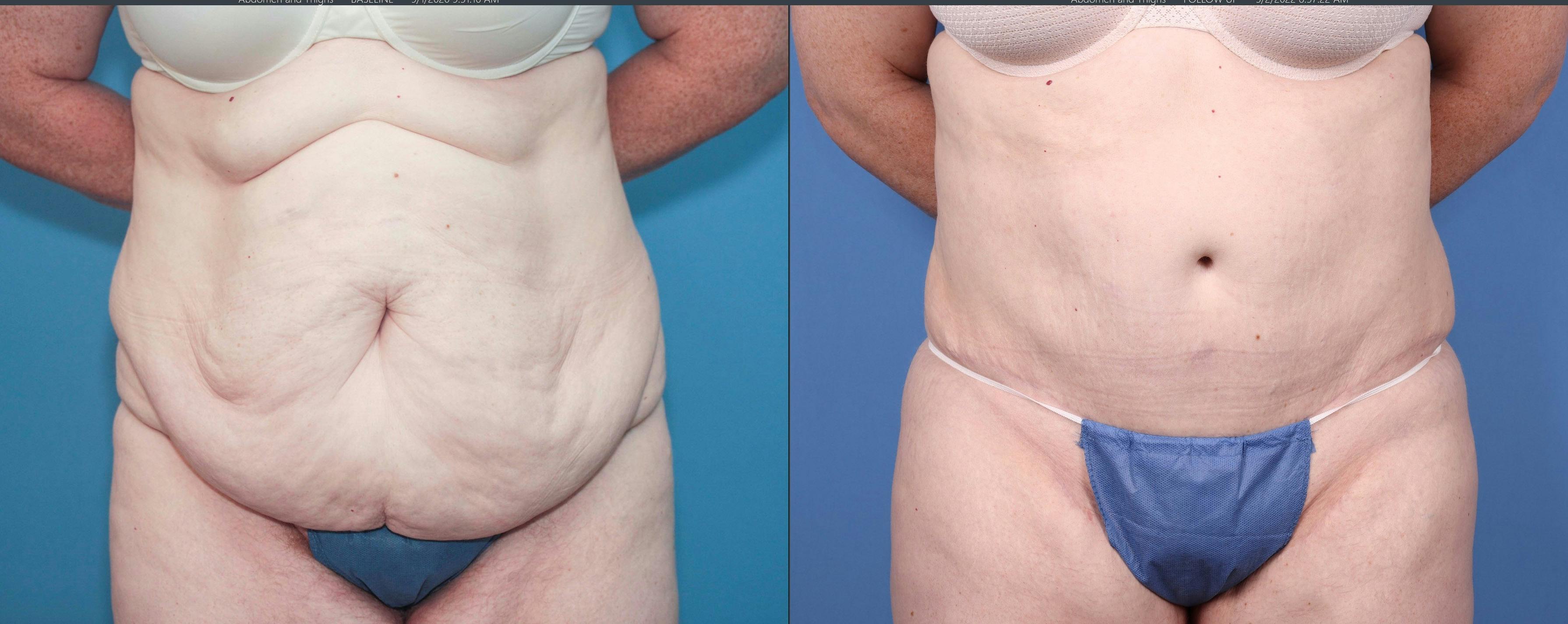 Thigh Lift Before & After Gallery - Patient 121459591 - Image 3