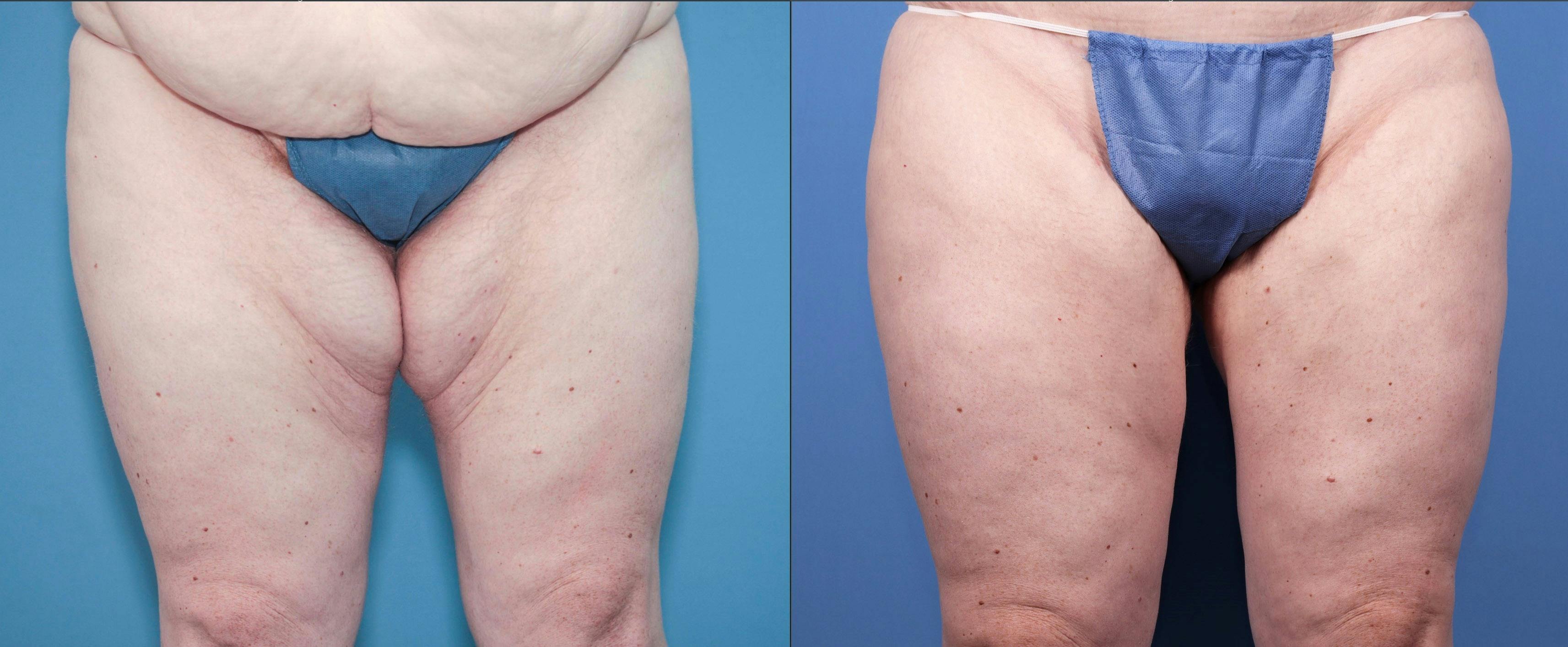 Tummy Tuck Before & After Gallery - Patient 121459580 - Image 4
