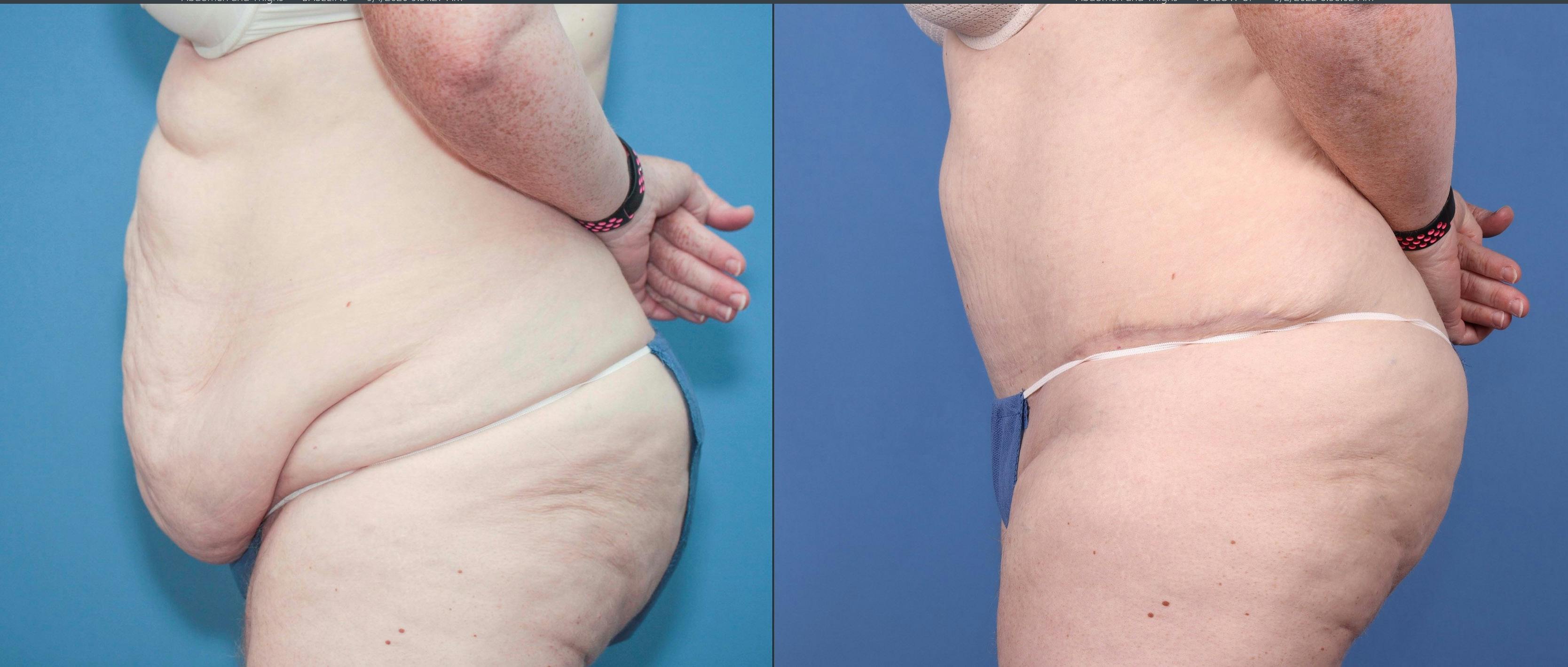 Tummy Tuck Before & After Gallery - Patient 121459580 - Image 3