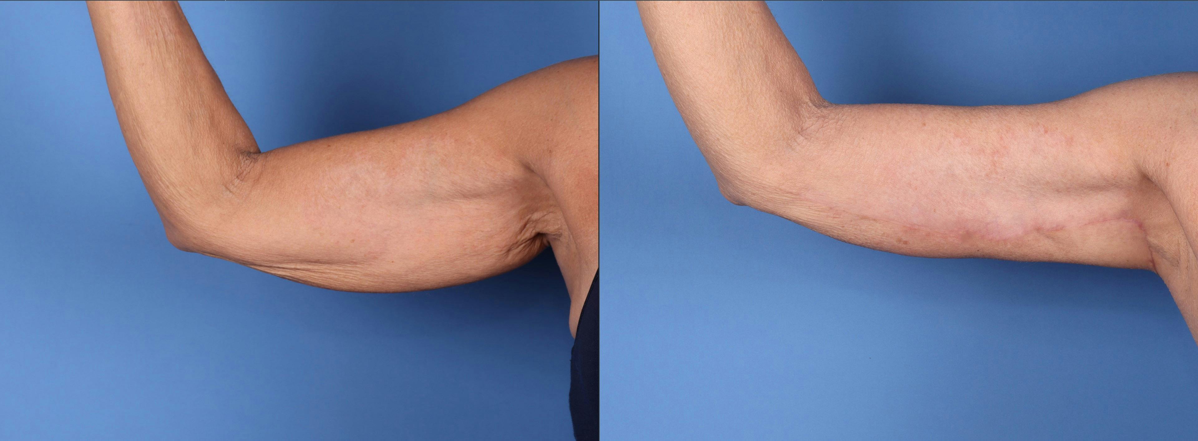Arm Lift Before & After Gallery - Patient 234548 - Image 1