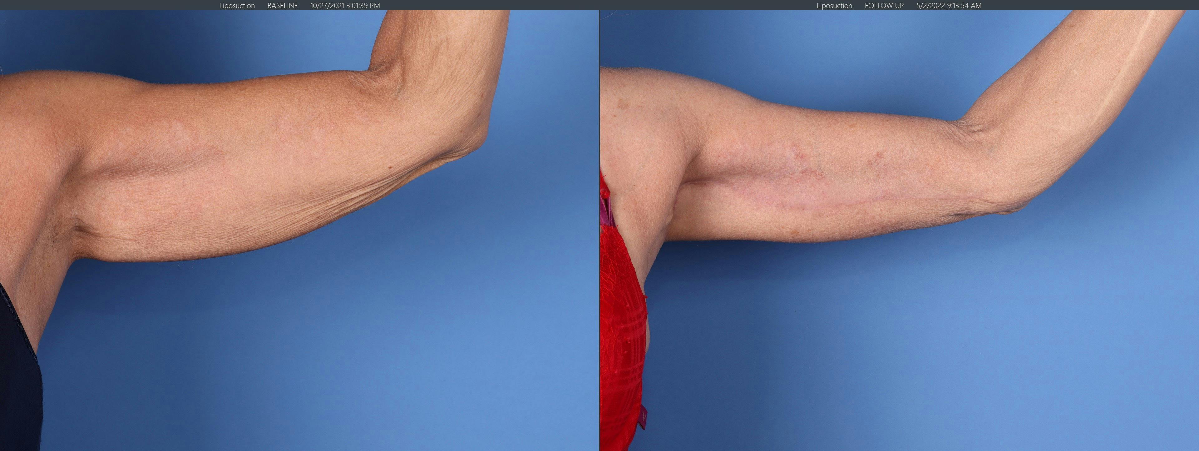 Arm Lift Before & After Gallery - Patient 121459672 - Image 2