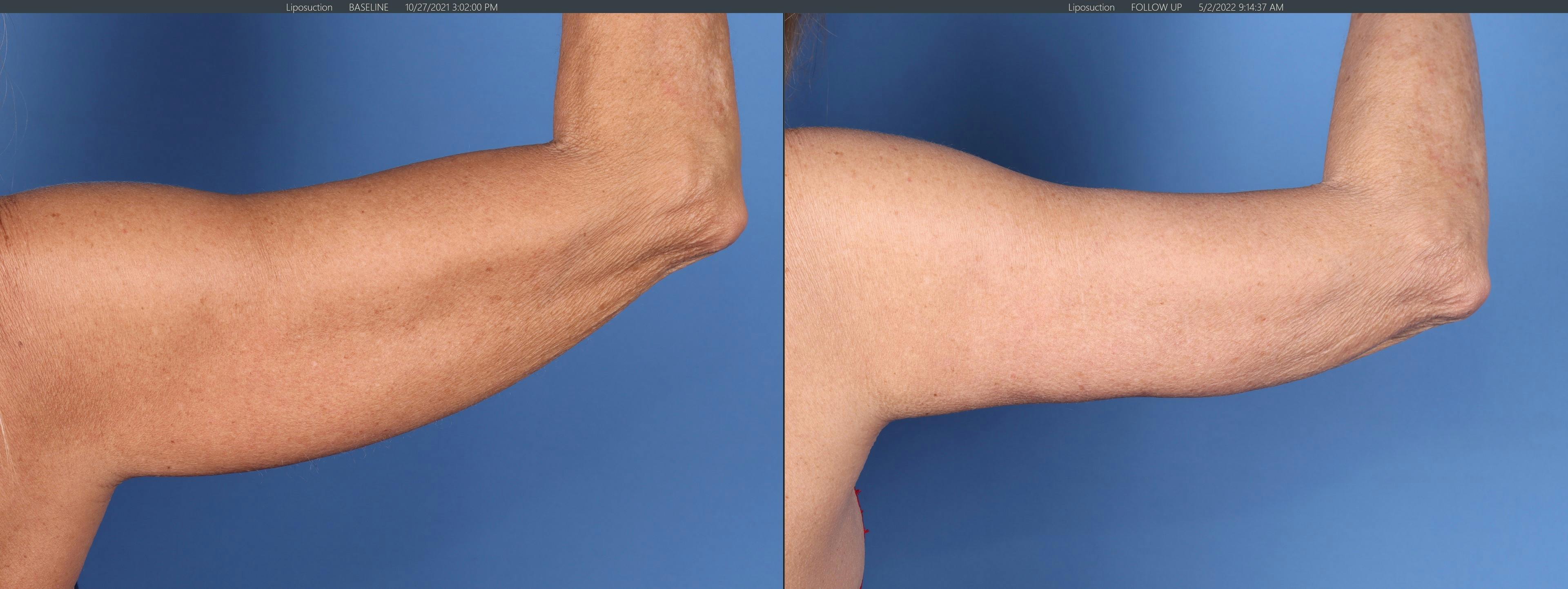 Arm Lift Before & After Gallery - Patient 121459672 - Image 3