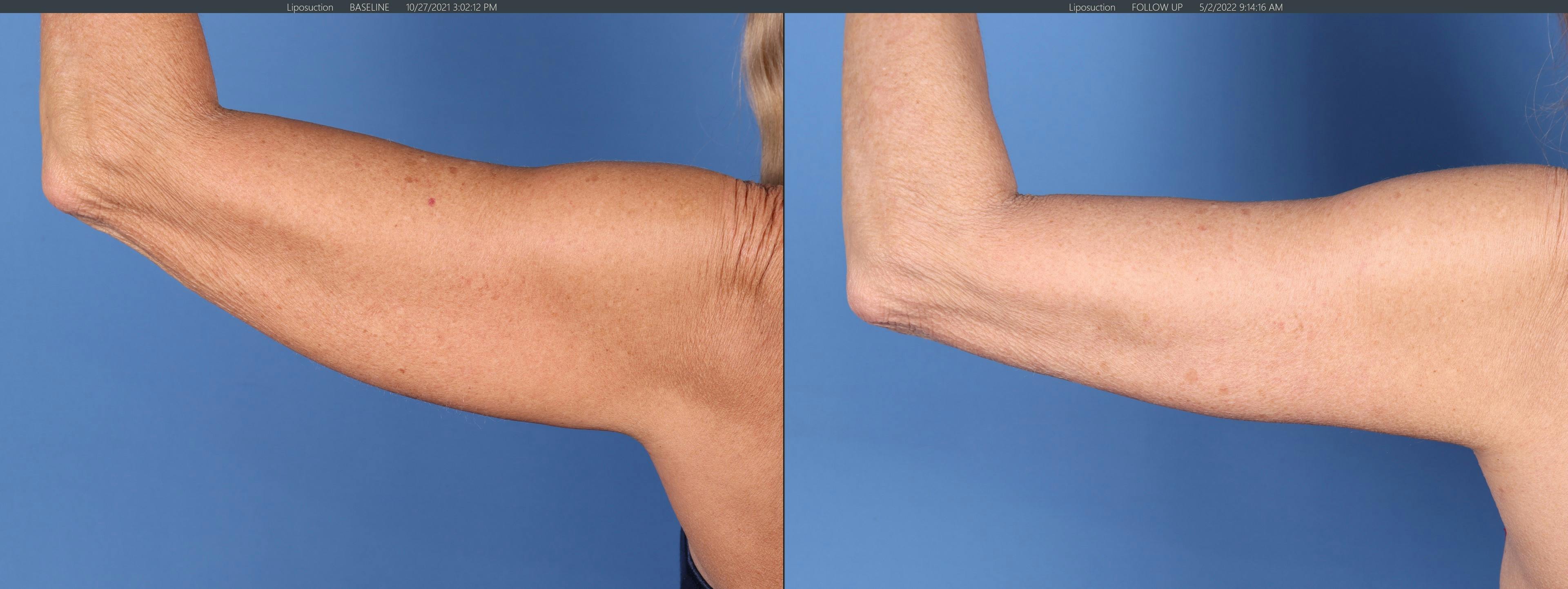 Arm Lift Before & After Gallery - Patient 121459672 - Image 4