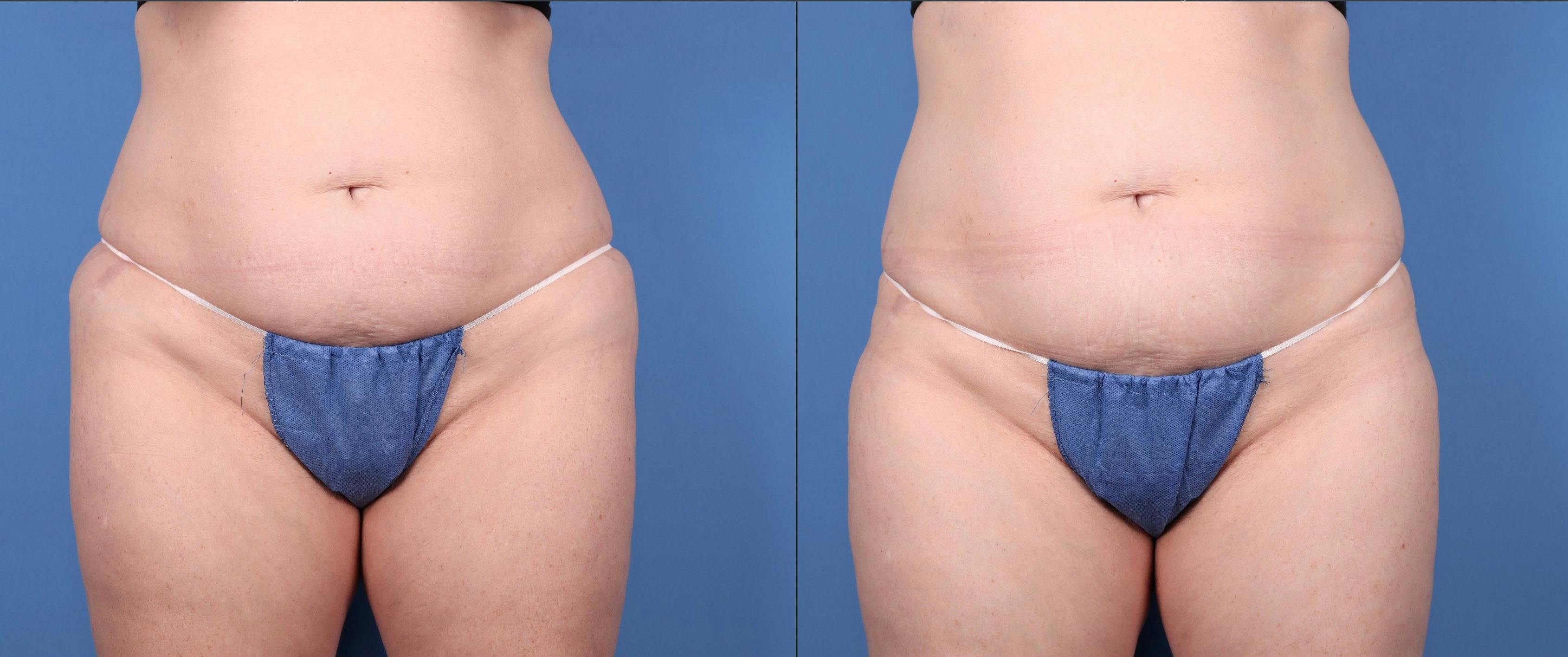 Abdomen Before & After Gallery - Patient 149385223 - Image 1