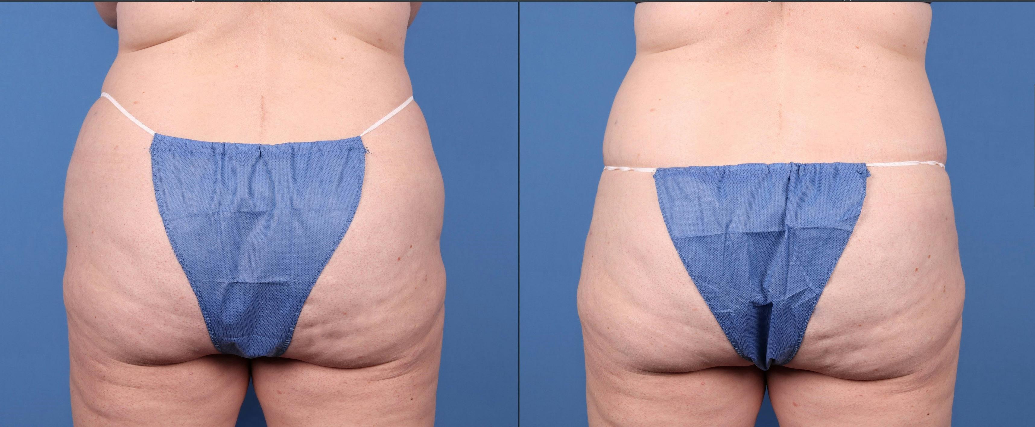 Liposuction Gallery - Patient 121459751 - Image 2