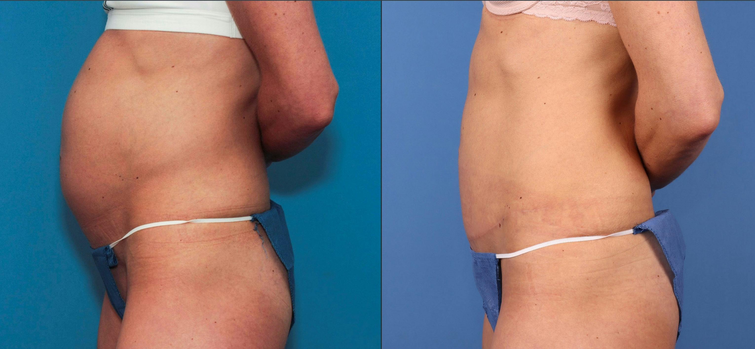 Tummy Tuck Before & After Gallery - Patient 121543651 - Image 3