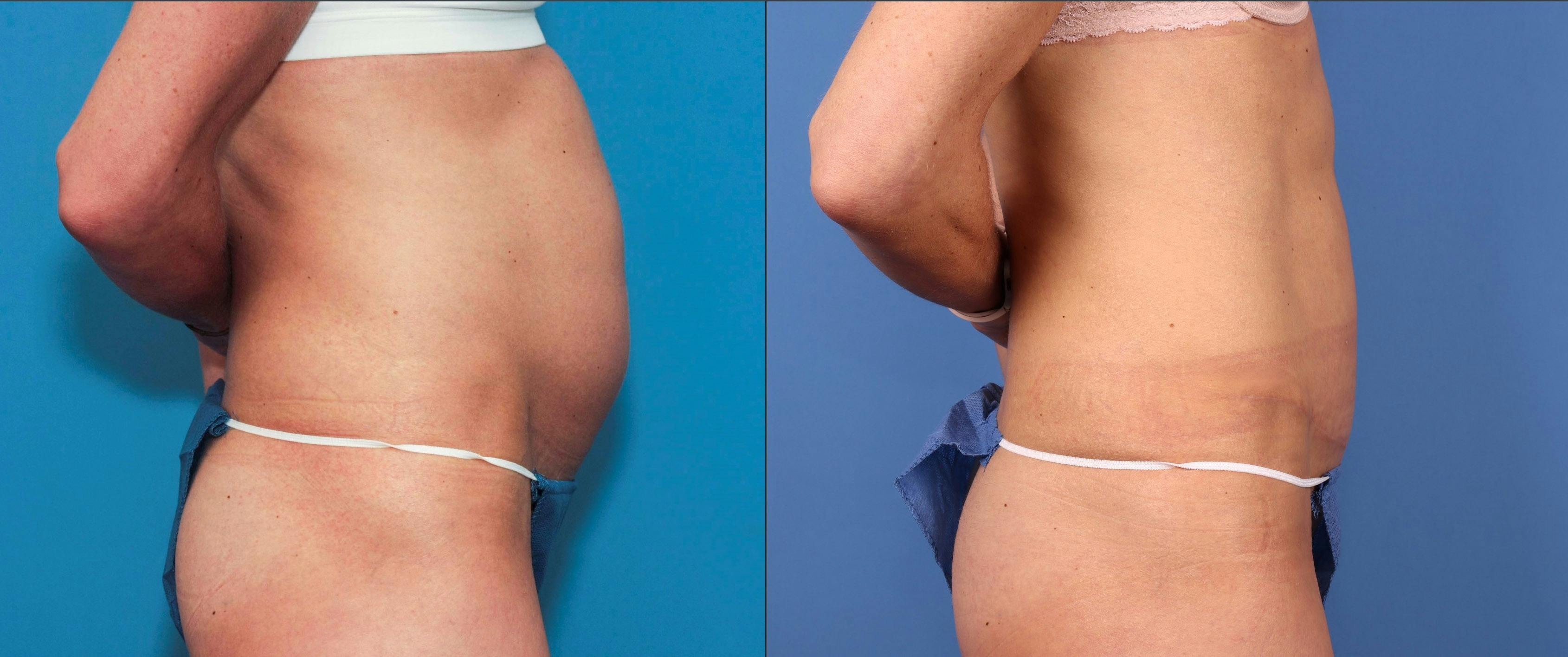 Tummy Tuck Before & After Gallery - Patient 121543651 - Image 2