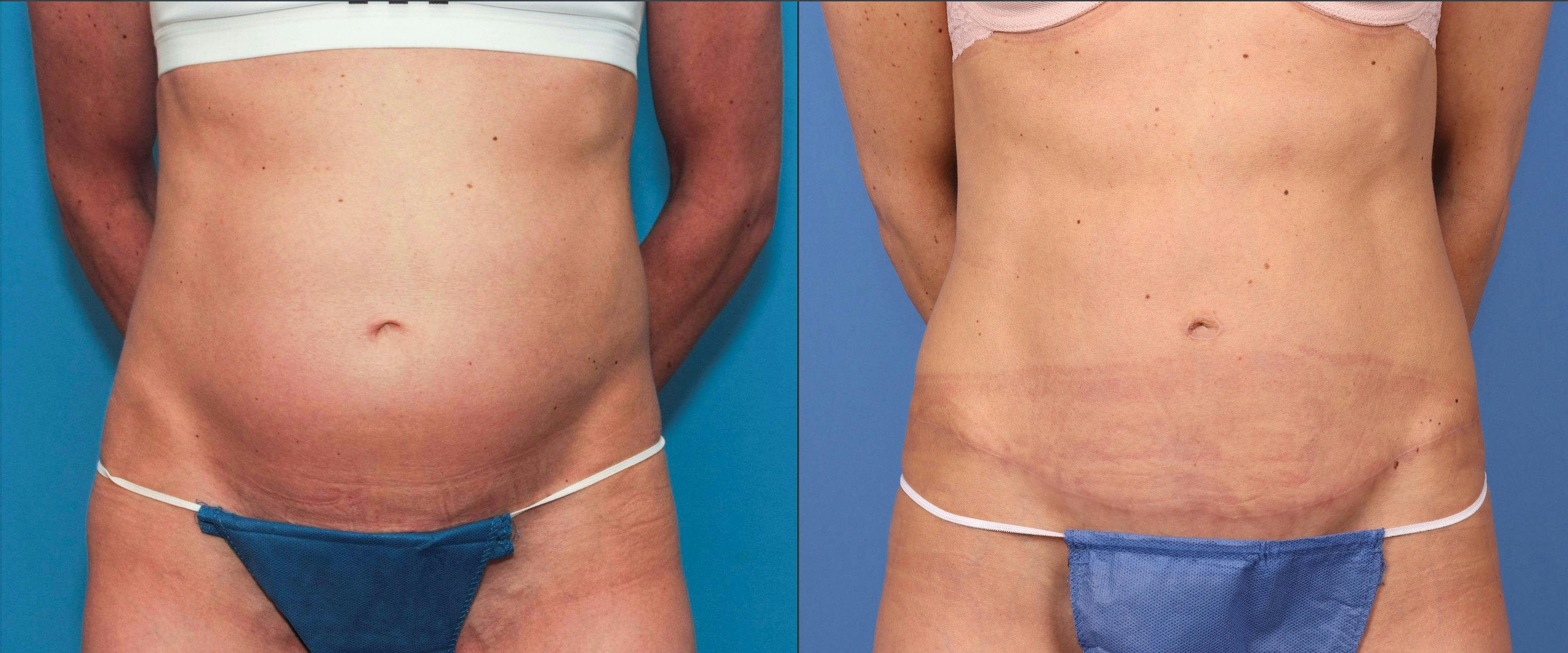 Tummy Tuck Before & After Gallery - Patient 121543651 - Image 1