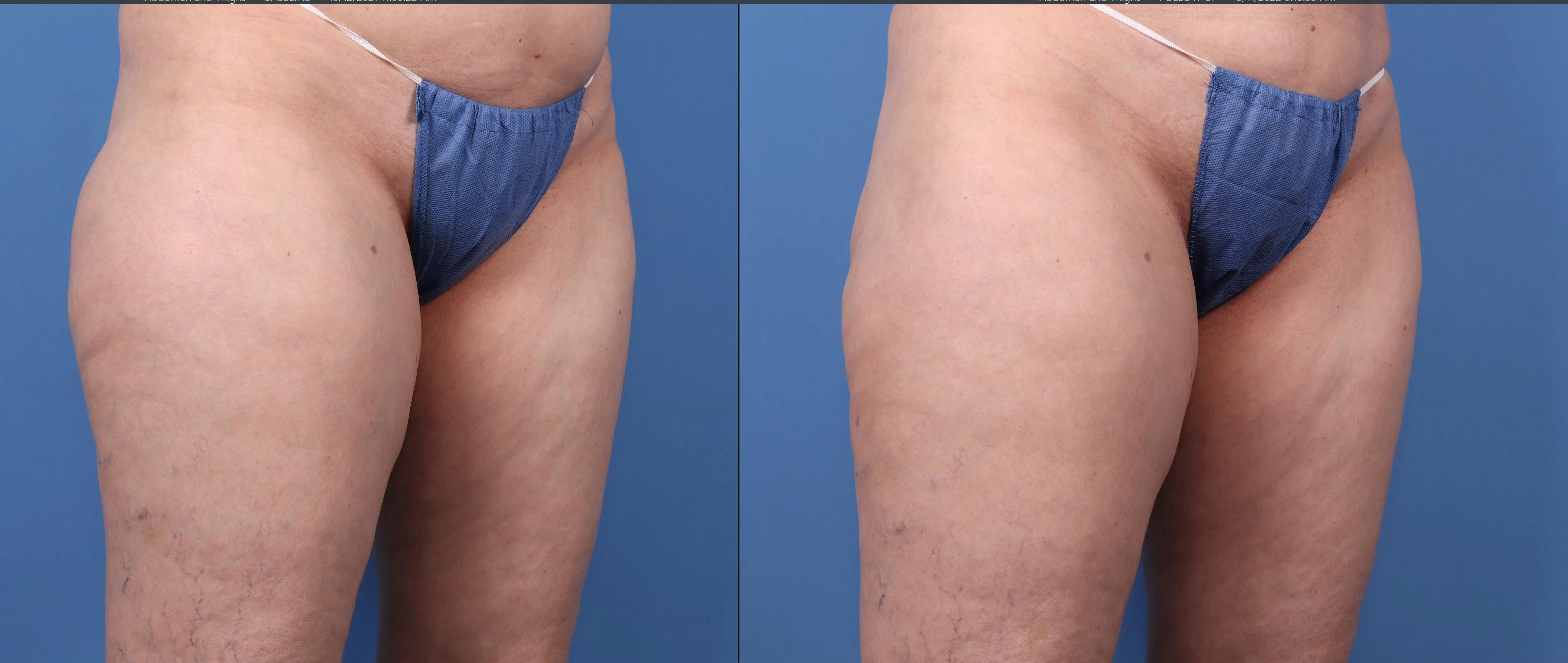 Liposuction Before & After Gallery - Patient 121619566 - Image 5