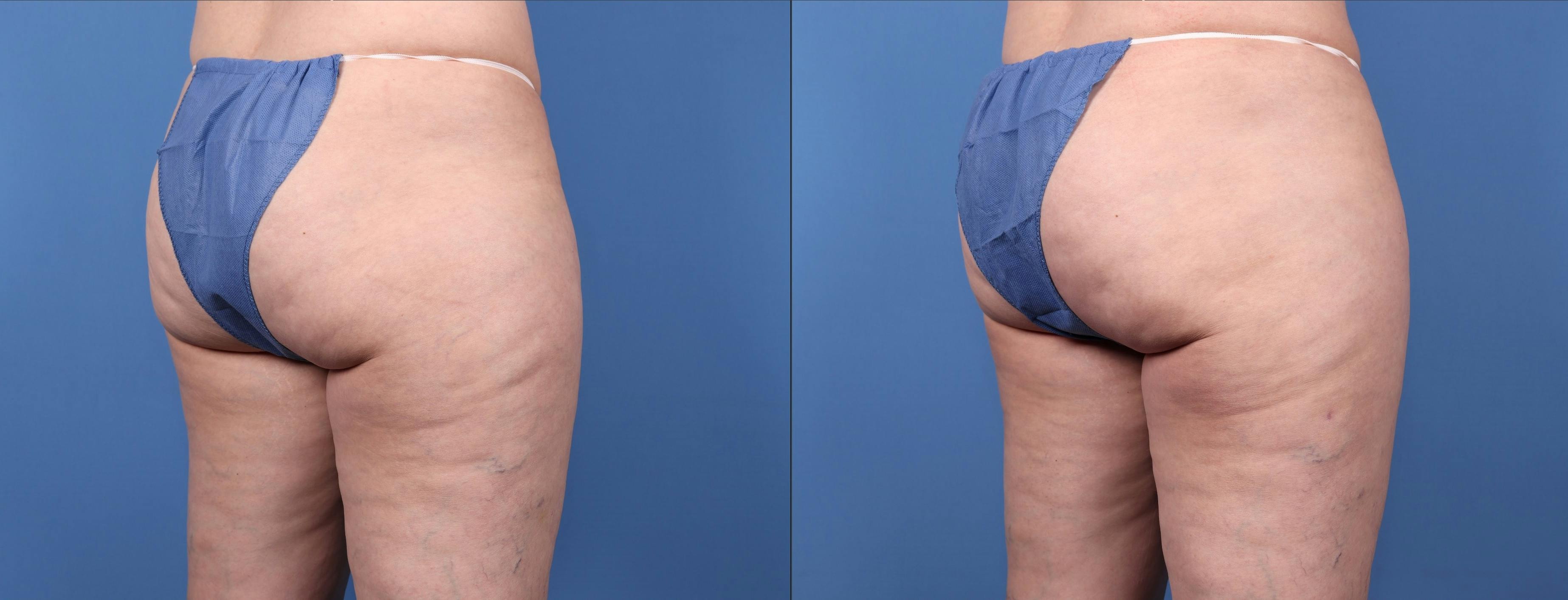Abdomen Before & After Gallery - Patient 149385222 - Image 6