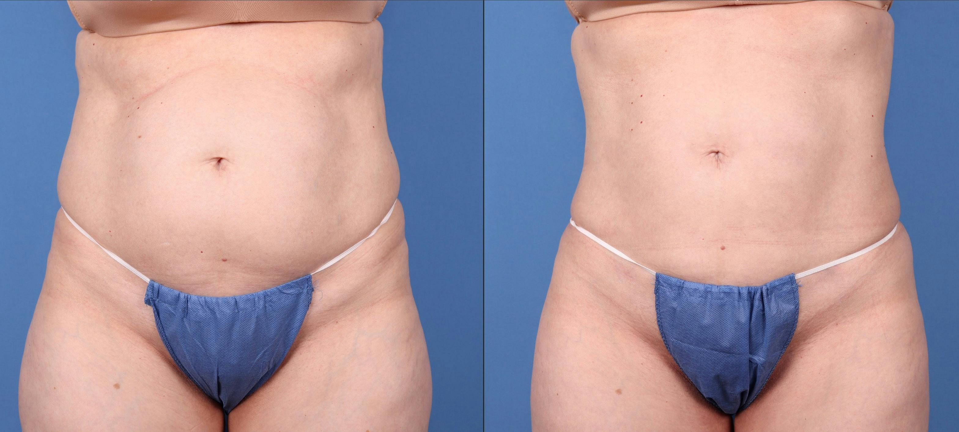 Liposuction Before & After Gallery - Patient 121619566 - Image 4
