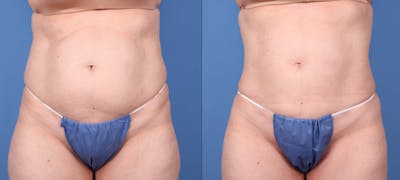 Abdomen Before & After Gallery - Patient 149385222 - Image 1