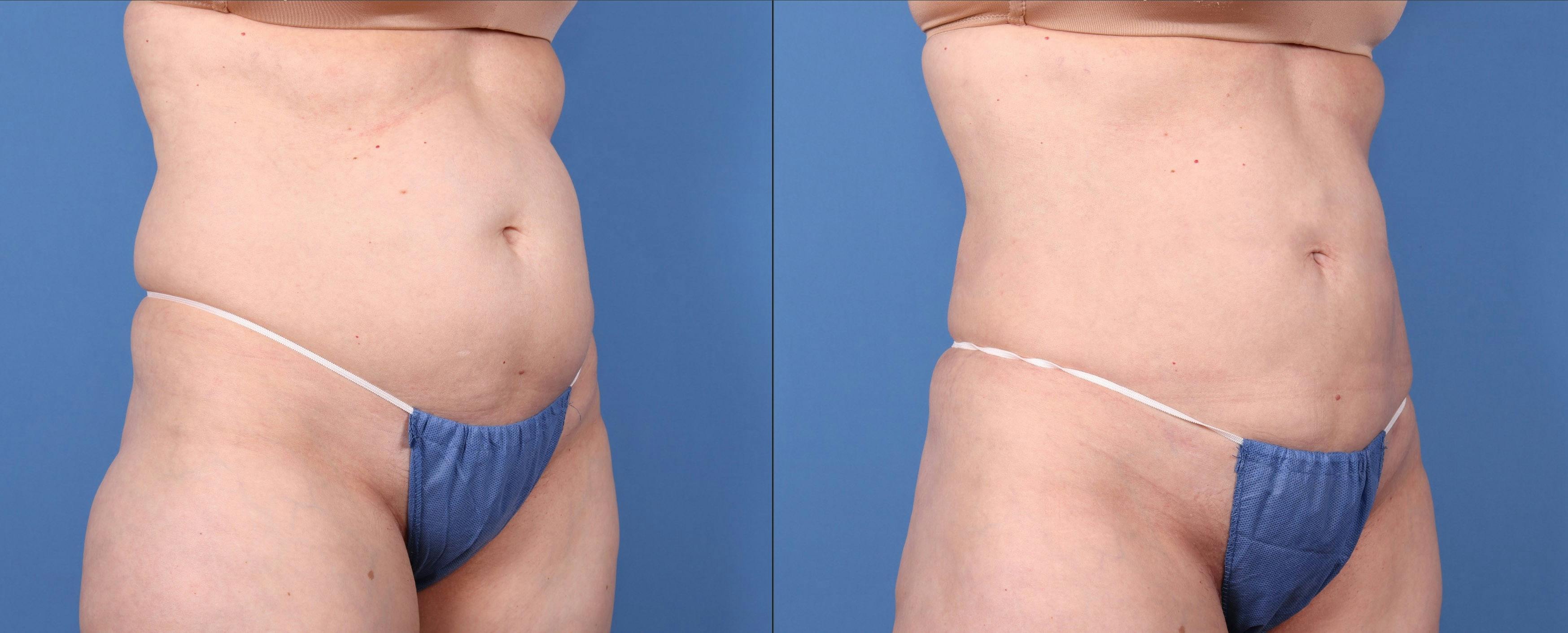 Abdomen Before & After Gallery - Patient 149385222 - Image 2