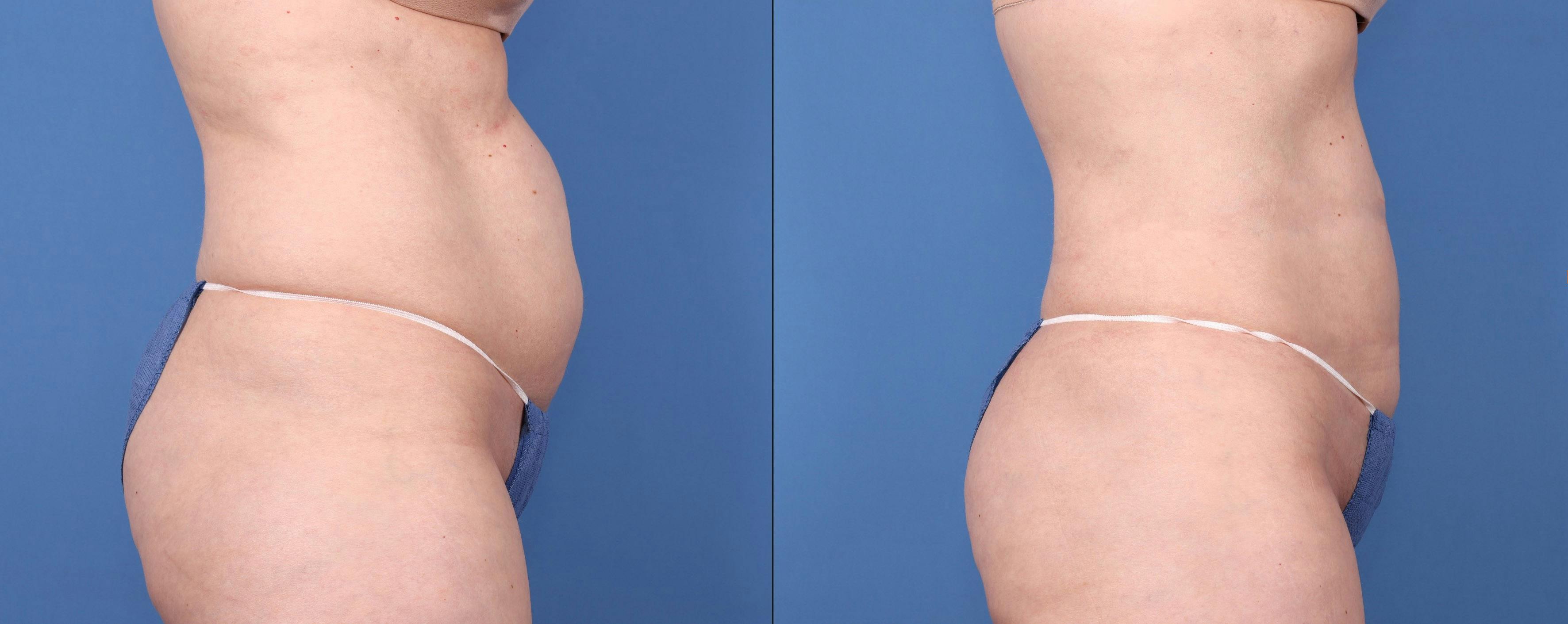Abdomen Before & After Gallery - Patient 149385222 - Image 3