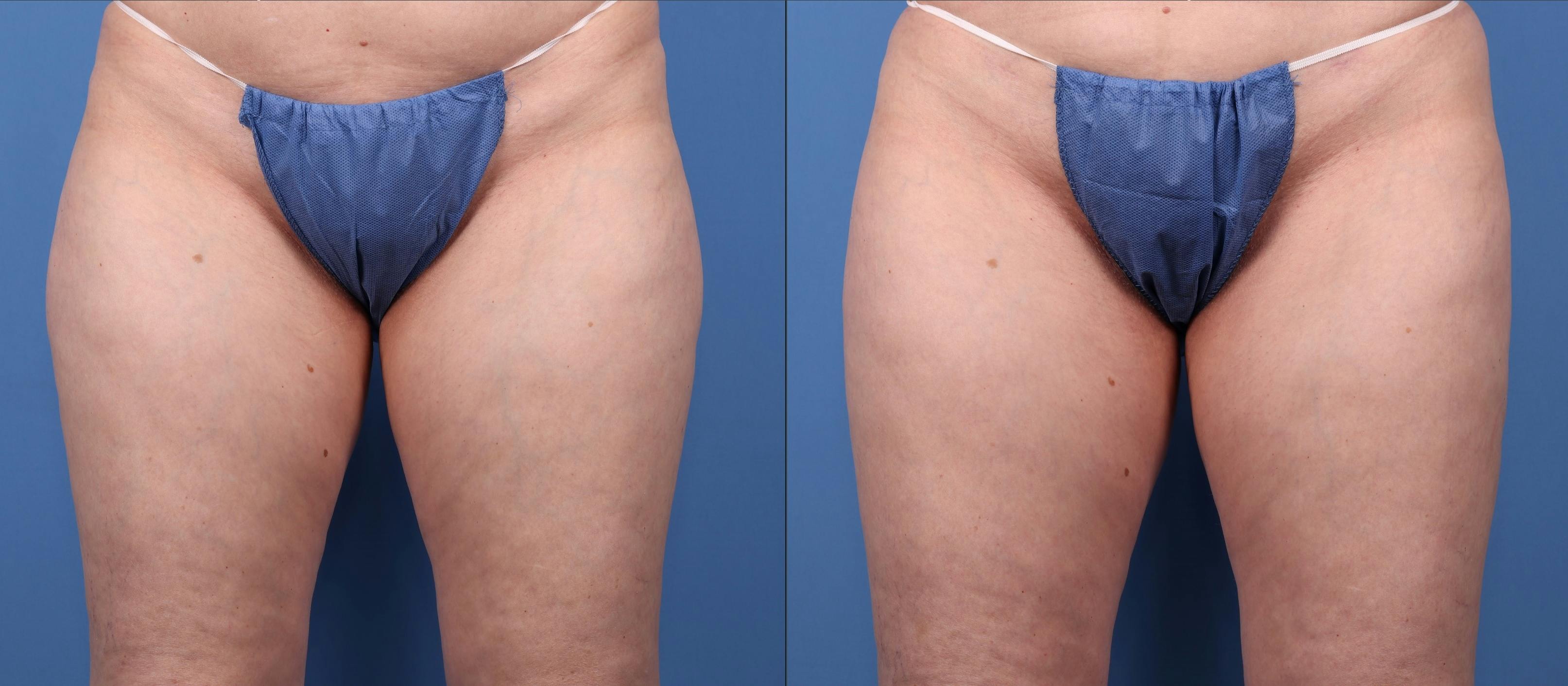 Abdomen Before & After Gallery - Patient 149385222 - Image 4