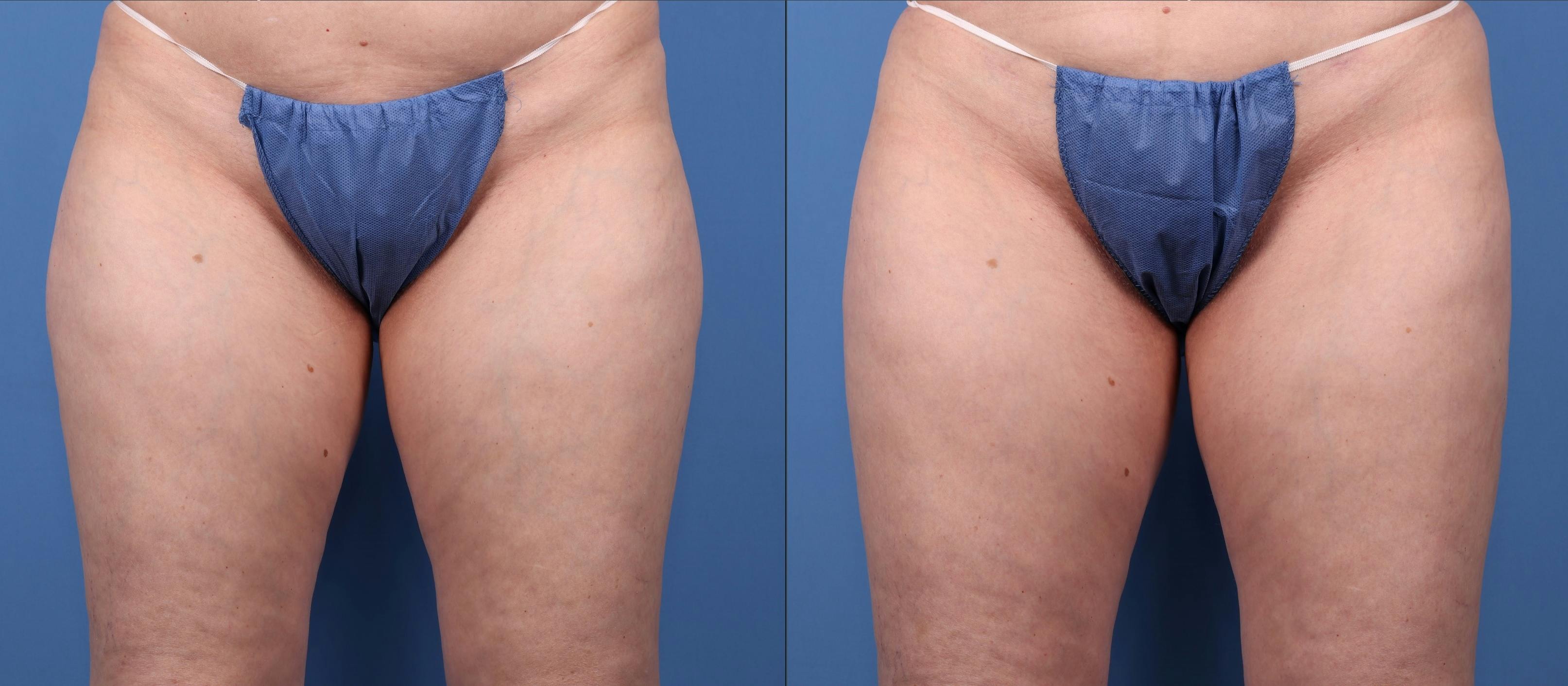 Liposuction Before & After Gallery - Patient 121619566 - Image 1
