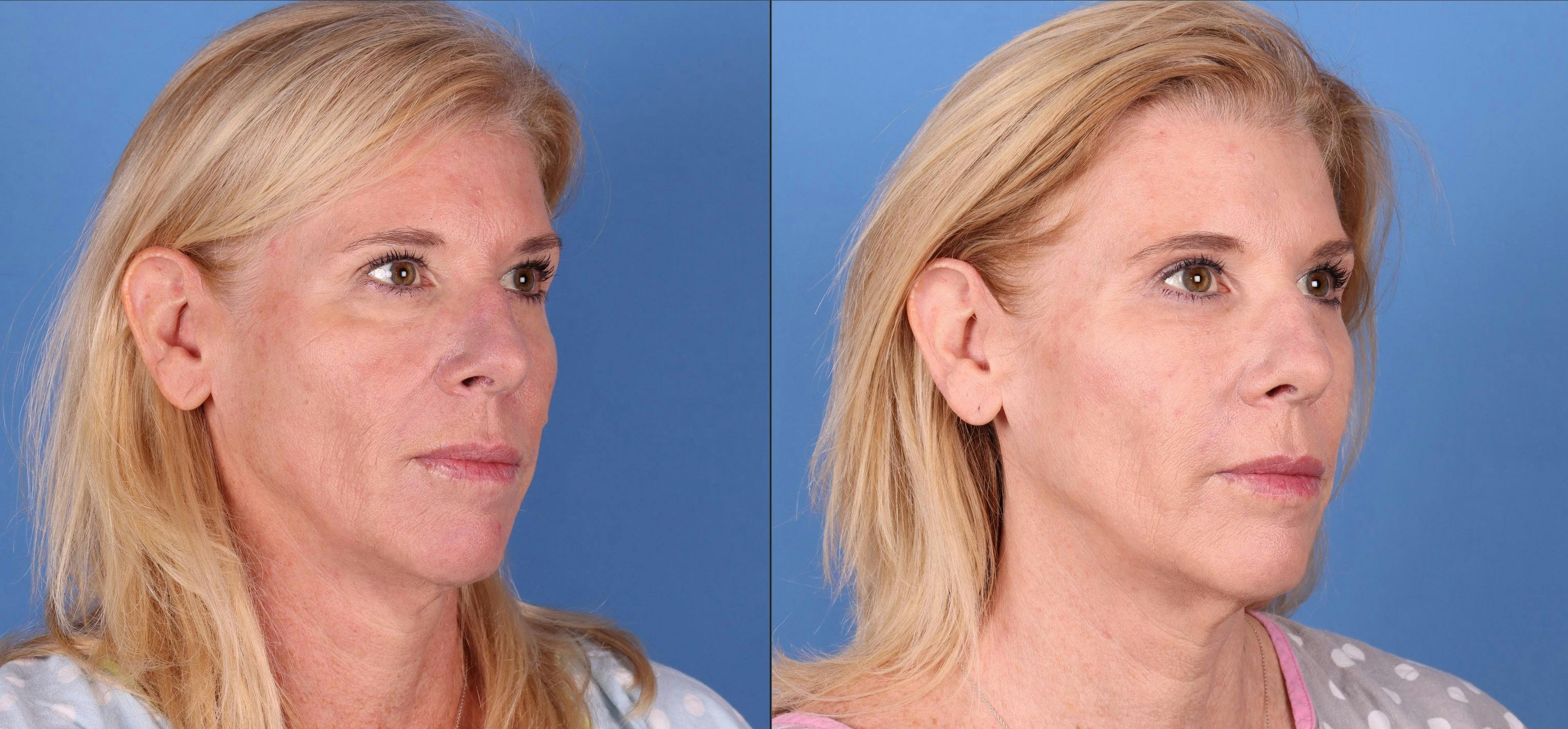 Fat Grafting Before & After Gallery - Patient 121619635 - Image 3