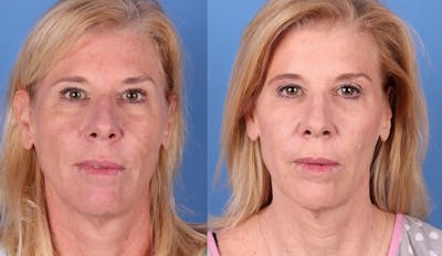 Fat Grafting Before & After Gallery - Patient 121619635 - Image 1