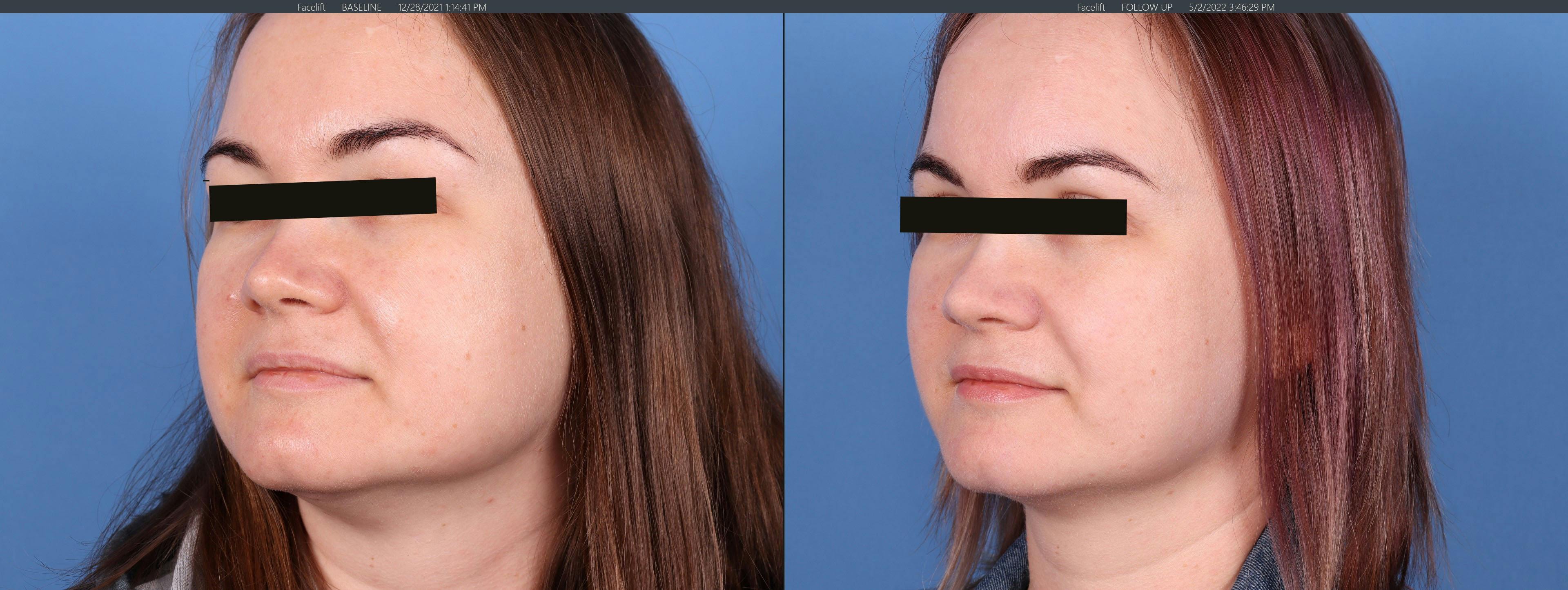 Dysport Before & After Gallery - Patient 121799447 - Image 2