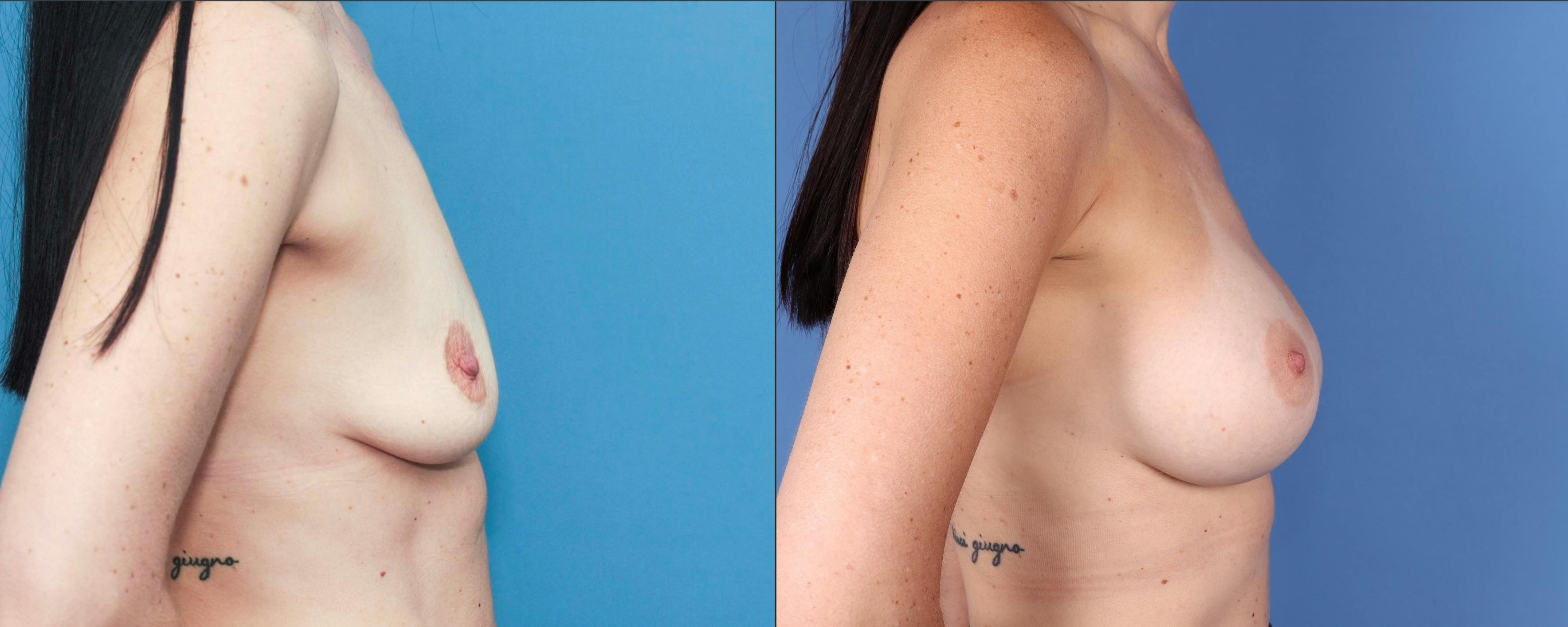Breast Augmentation Before & After Gallery - Patient 121799522 - Image 3