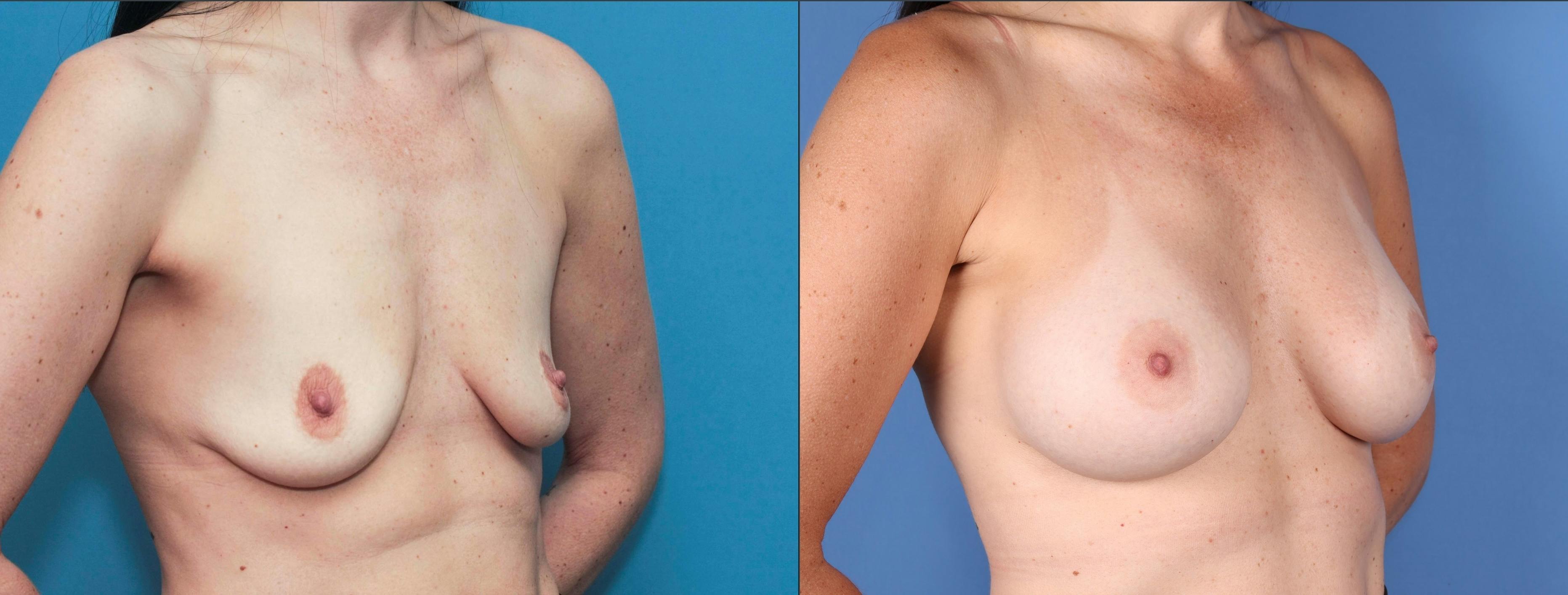 Breast Augmentation Before & After Gallery - Patient 121799522 - Image 2