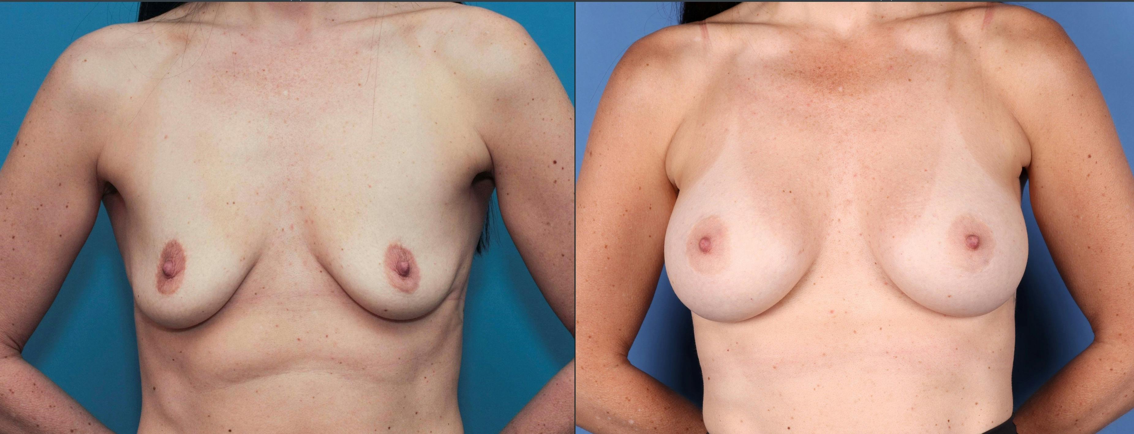 Breast Augmentation Before & After Gallery - Patient 121799522 - Image 1