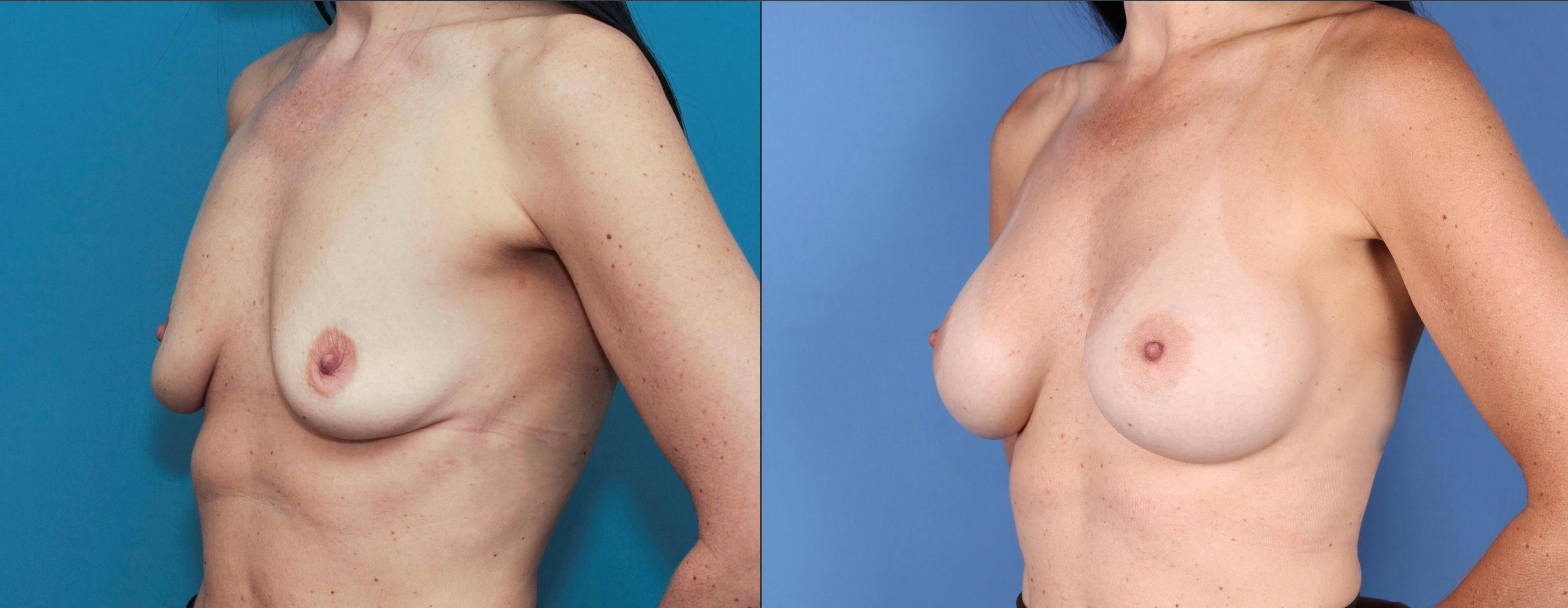 Breast Augmentation Before & After Gallery - Patient 121799522 - Image 4