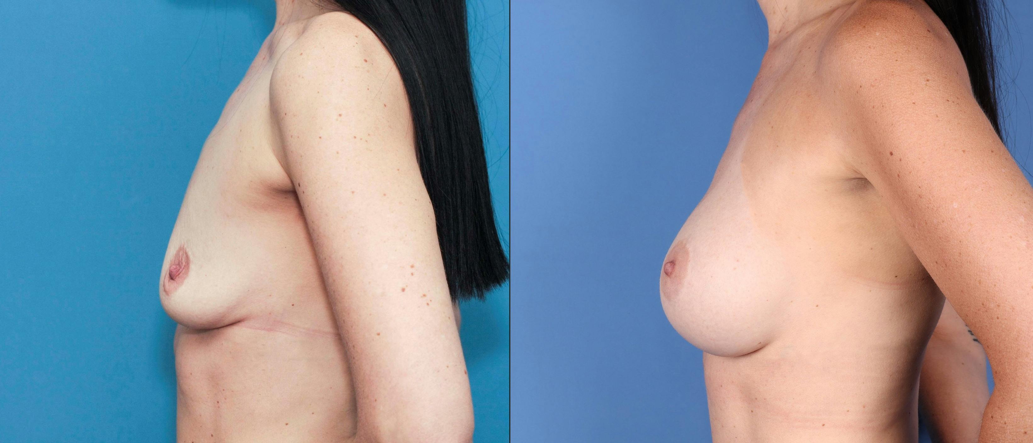 Breast Augmentation Before & After Gallery - Patient 121799522 - Image 5