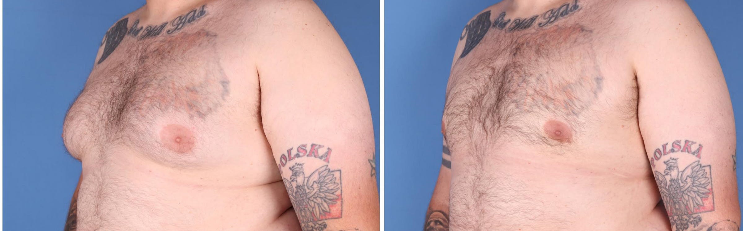 Male Breast Reduction Before & After Gallery - Patient 121819033 - Image 4