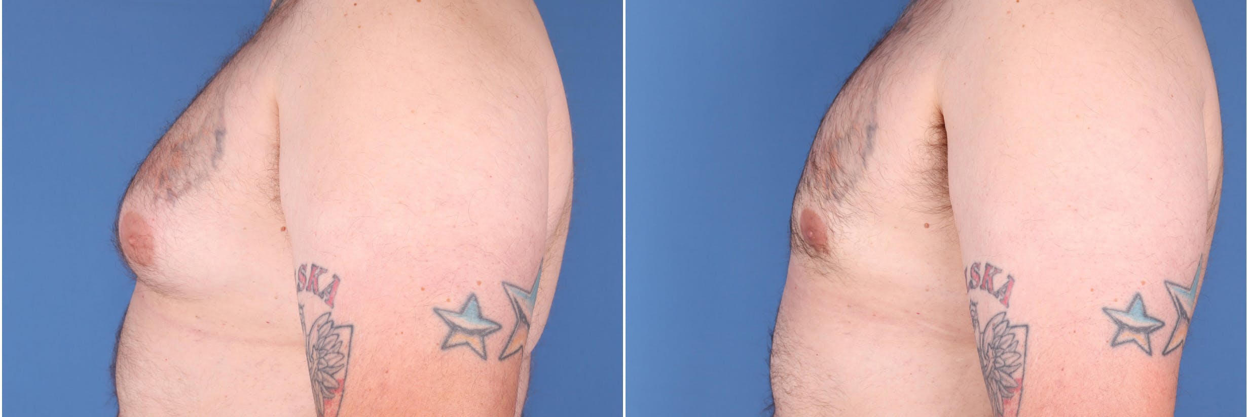 Male Breast Reduction Before & After Gallery - Patient 121819033 - Image 5