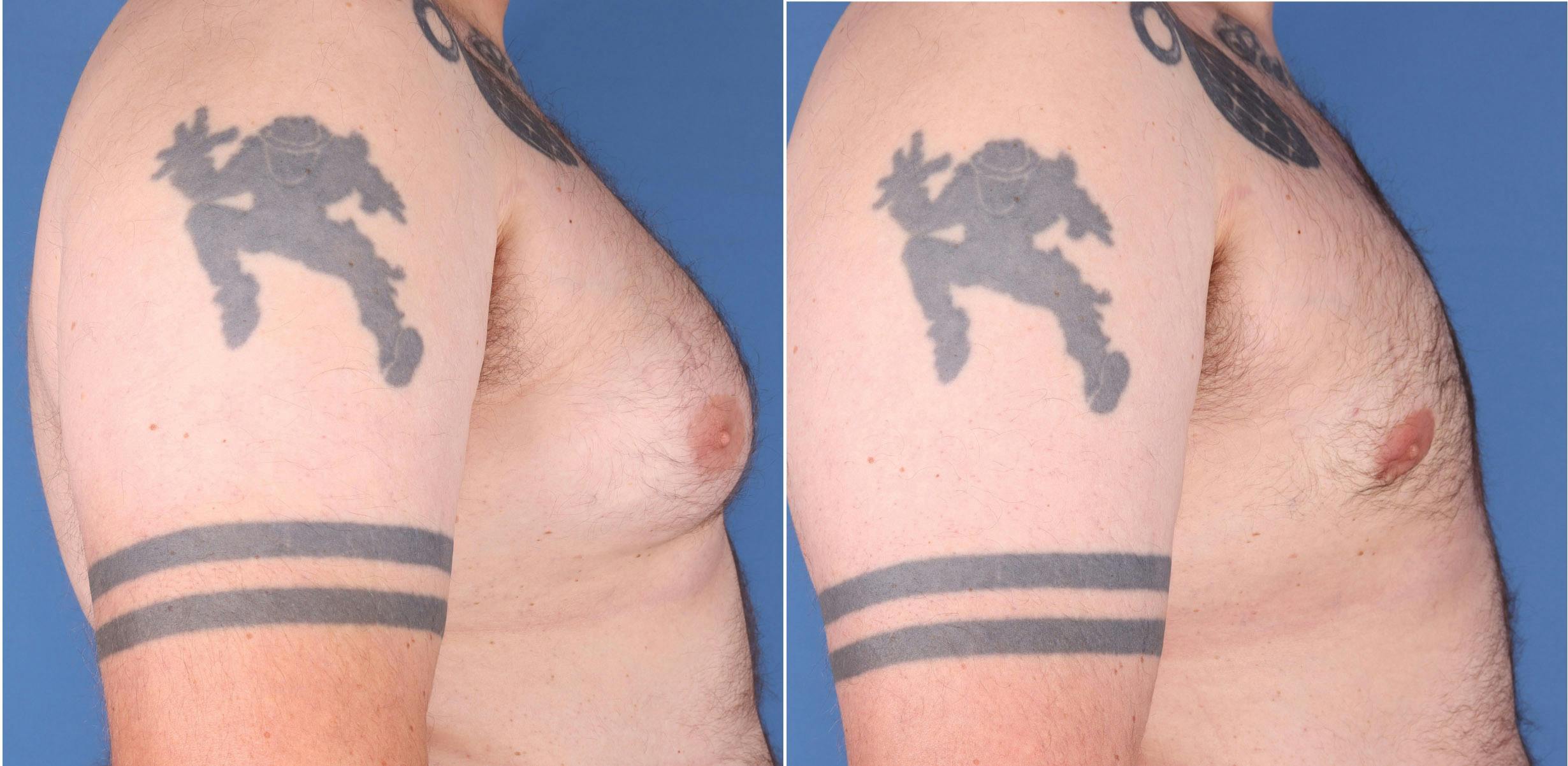 Male Breast Reduction Before & After Gallery - Patient 121819033 - Image 3