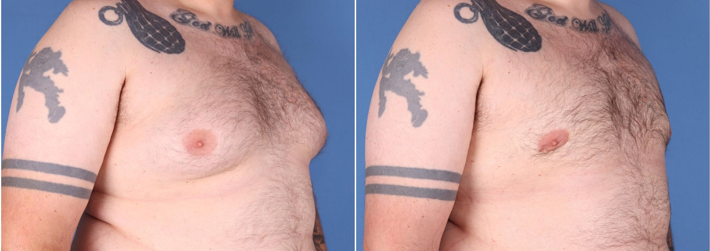 Male Breast Reduction Before & After Gallery - Patient 121819033 - Image 2
