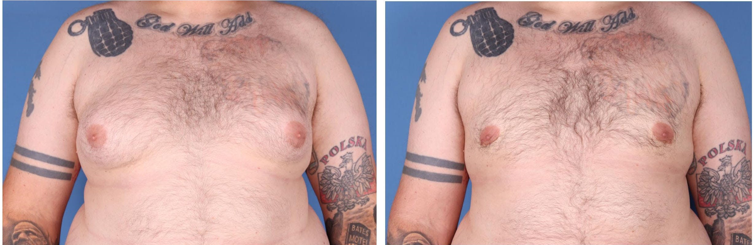 Male Breast Reduction Before & After Gallery - Patient 121819033 - Image 1